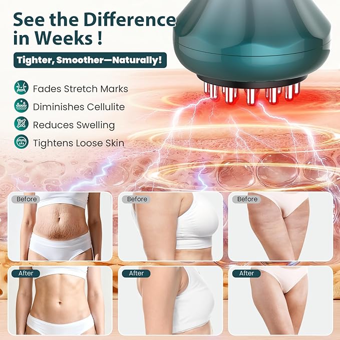 Lymphatic Drainage Massager, Anti-Cellulite Massager For Body Cellulite and Thigh & Belly Stretch Marks Reduction, Handheld Massage tools for lymphedema & lipedema, Sciatica Nerve pain relief Devices