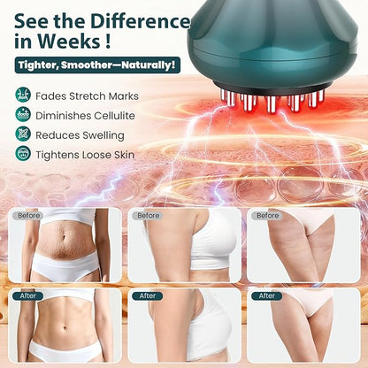 Lymphatic Drainage Massager, Anti-Cellulite Massager For Body Cellulite and Thigh & Belly Stretch Marks Reduction, Handheld Massage tools for lymphedema & lipedema, Sciatica Nerve pain relief Devices